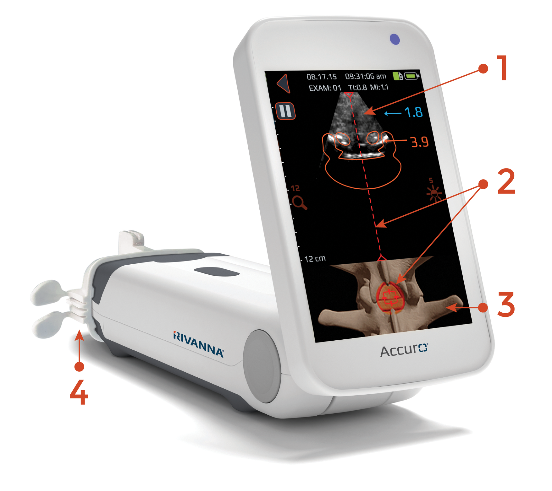 Rivanna-Accuro-lumbar-image-guidance-identify-epidural-space