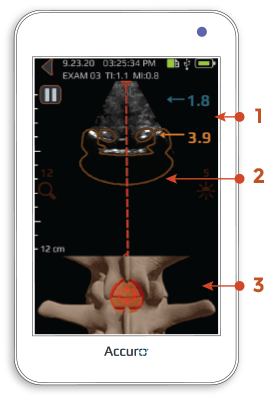 accuro-lumbar-scouting-technique-find-epidural-space